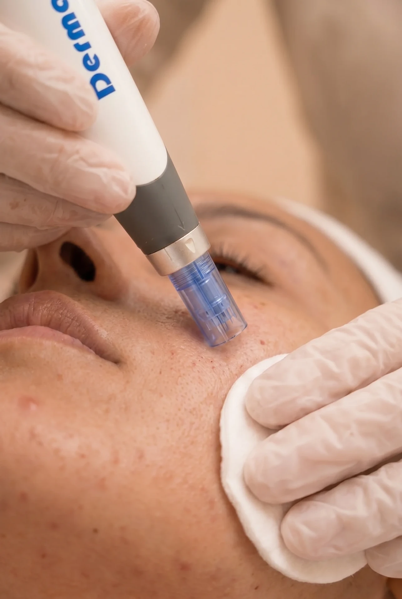 Acne behandeling foto 2